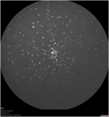 Real-Time Imaging of Retinal Cell Apoptosis by Confocal Scanning Laser Ophthalmoscopy and Its Role in Glaucoma